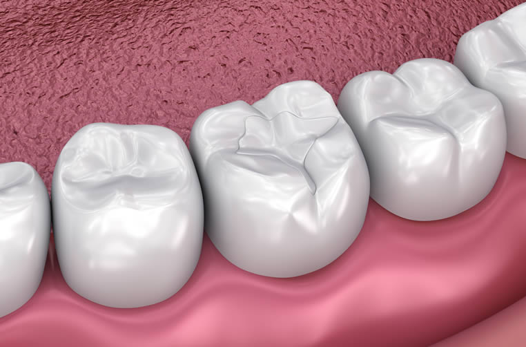 Tooth Colour Fillings